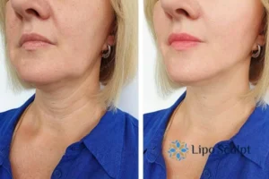 Double chin before and after Hi-Fu treatment 4 Book your double chin treatment Bushey today! We are here to help!