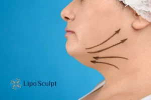 Double chin before and after Hi-Fu treatment 3 Boost your confidence with a Double chin treatment Bushey