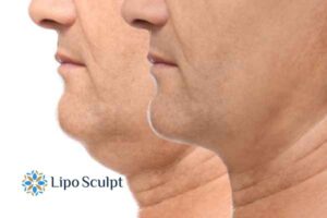 Double chin before and after Hi-Fu treatment 2 Double chin treatment Bushey from Lipo Sculpt - feel more confident today!