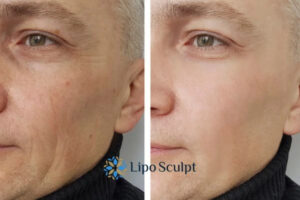 How to Fight Aging Symptoms 3 Fight Aging Symptoms Bushey With HIFU and Morpheus8 Today!