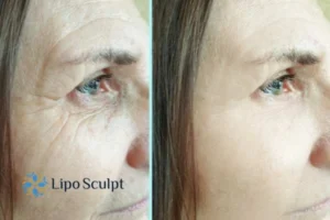 How to Fight Aging Symptoms 2 Do you want to Fight Aging Symptoms Bushey? Contact Lipo Sculpt today!