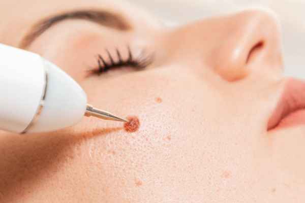CryoPen: 5 Skin Concerns It May Be Used to Treat 3 What actually happens during a CryoPen treatment Bushey?