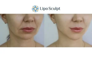 Explaining Total Skin Tightening Treatment And What It Can Do For You 2 Do you want to boost your self confidence? Give Morpheus8 Bushey a try today!