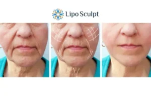 Explaining Total Skin Tightening Treatment And What It Can Do For You 3 Boost your confidence with Morpheus8 Bushey call our team today!