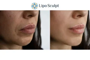 Explaining Total Skin Tightening Treatment And What It Can Do For You 4 Morpheus8 Bushey the best results - call our team today!