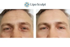 Explaining Total Skin Tightening Treatment And What It Can Do For You 6 Morpheus8 Bushey book in today to find out more!