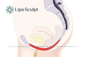 Pelvic Floor Chair Therapy 1 Pelvic Floor Chair Therapy Bushey to treat incontinence.
