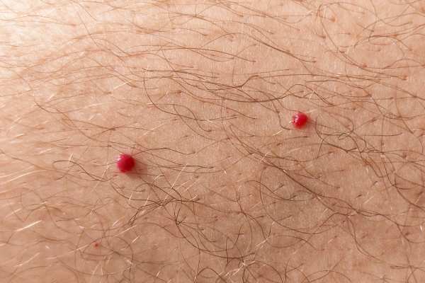 CryoPen: 5 Skin Concerns It May Be Used to Treat 2 cherry angioma removal Bushey