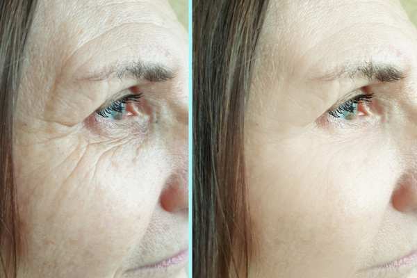 Why Do People Choose HIFU for a Non-Surgical Facelift? 4 How long can HIFU results last Bushey?