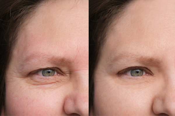 HIFU vs Botulinum Toxin: Understanding the Differences 4 How long do HIFU results last Bushey?
