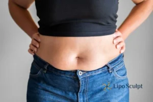 Bidding Farewell to Muffin Tops with Aqualyx Fat Injections 2 Do you wish you could reduce your muffin top Bushey With Aqualy fat dissolving injections you can!