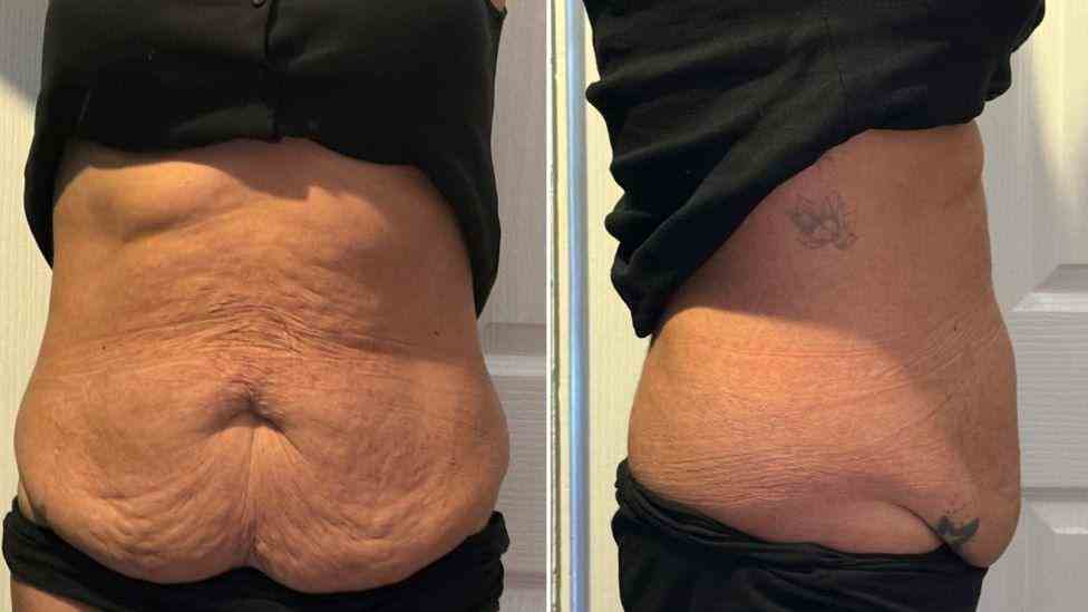 Lost the Weight but Not the Loose Skin? What You Should Know 1 Is It Definitely Loose Skin Bushey?